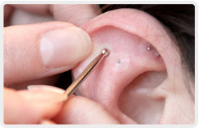 ear acupressure edmonton